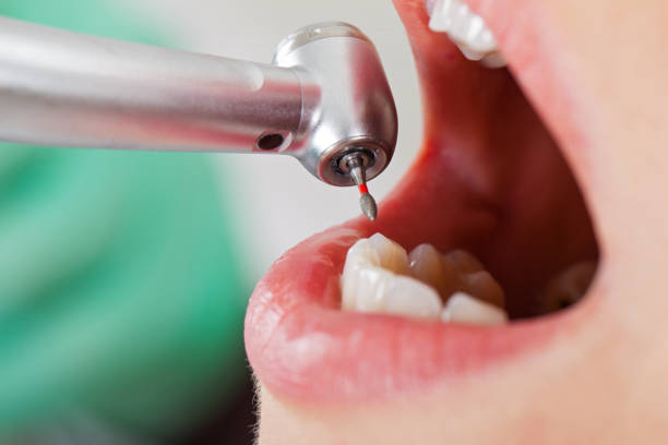 Best Emergency Dentist for Lost Fillings or Crowns in Flint, MI